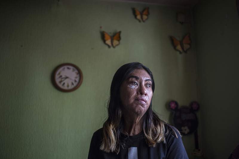 Survivors of acid attacks in Mexico unite to push for change
