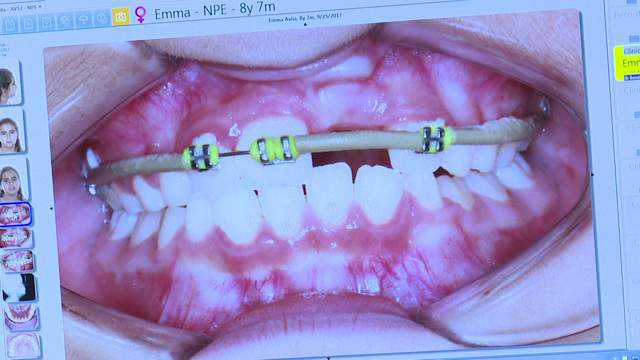 Spencer Solves It: New braces for 8-year-old girl