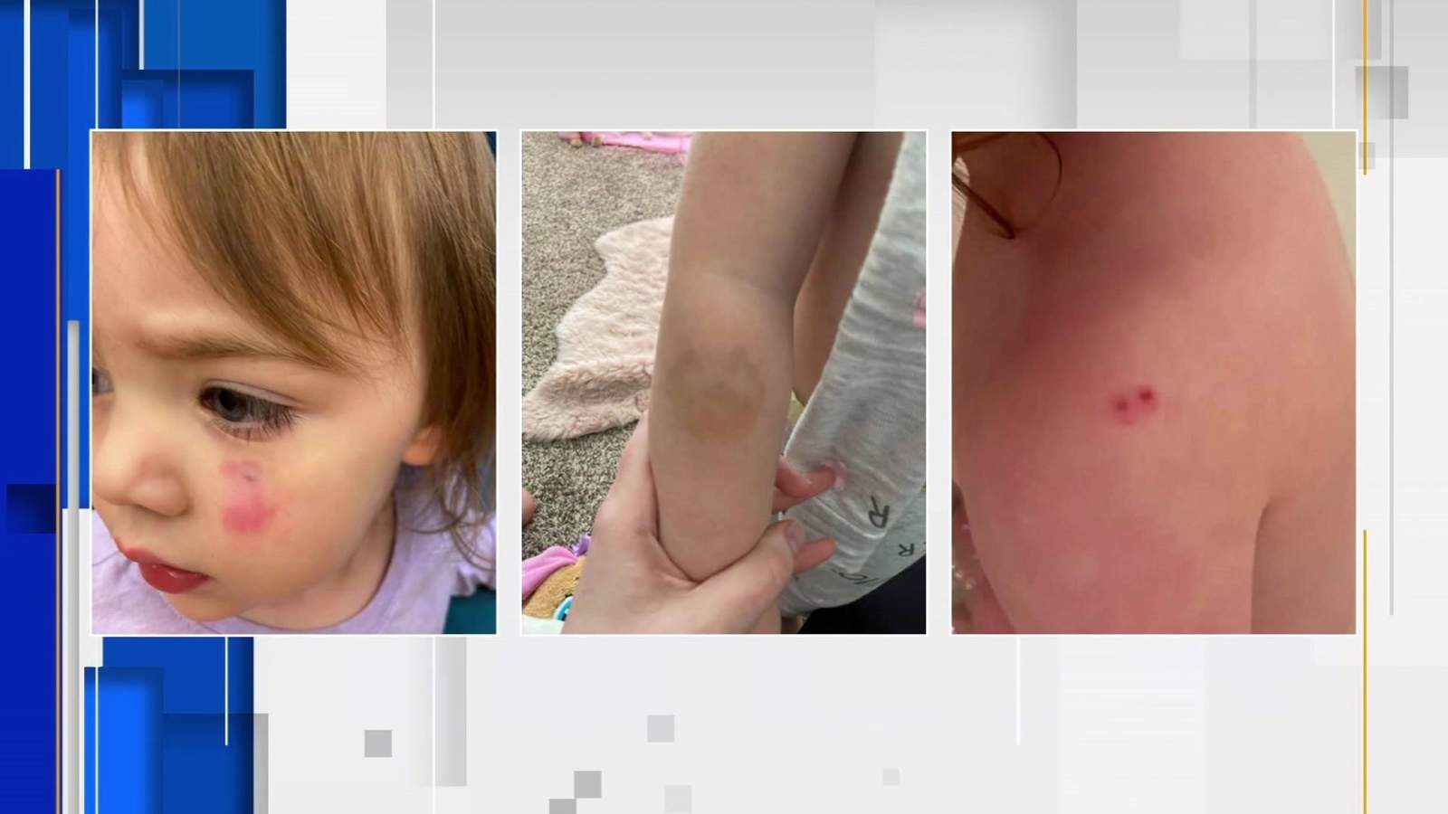Mother upset with how daycare handled her daughter’s injuries