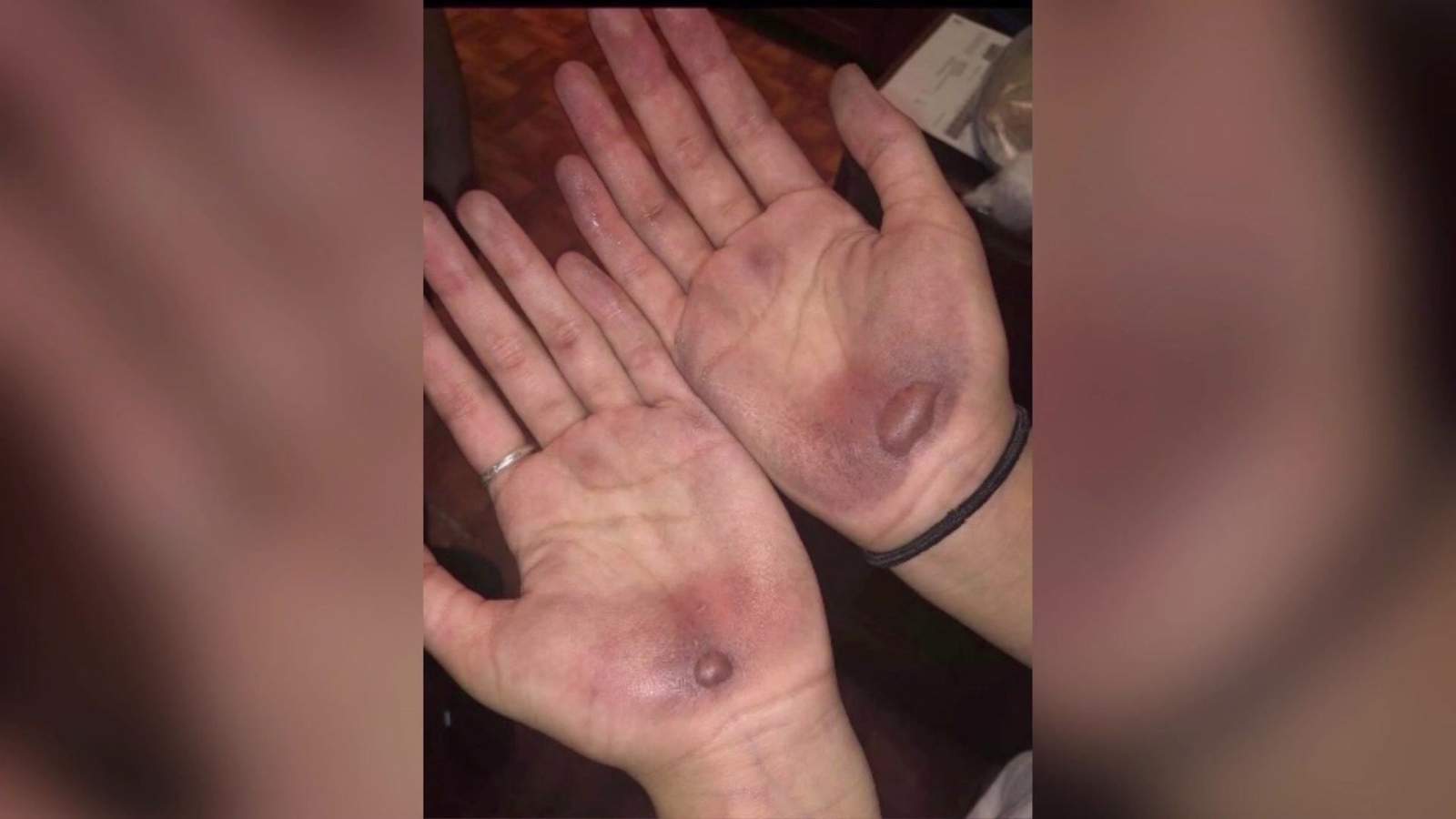 Clute middle school teacher on leave after several students hands were severely blistered from bear crawl punishment
