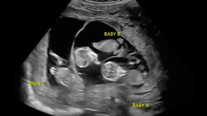 First-time parents expecting triplets in a remarkable double pregnancy