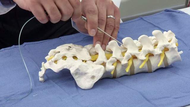 Revolutionary spine surgery takes pain, long recovery away for most patients