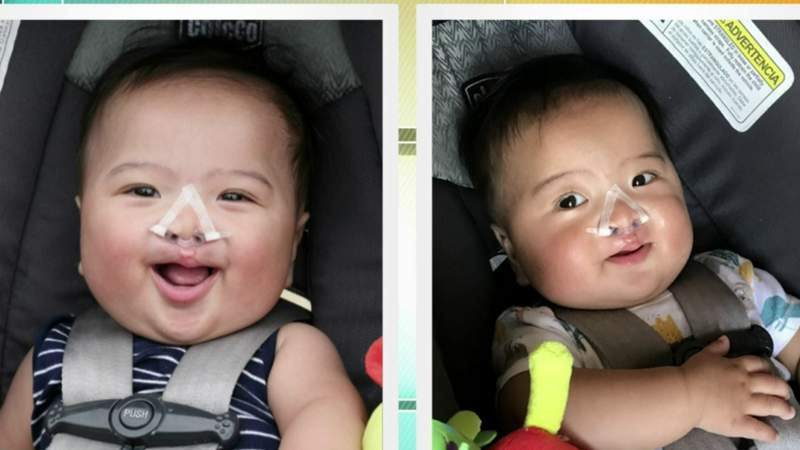 How one local family found treatment for their baby boy’s bilateral cleft lip