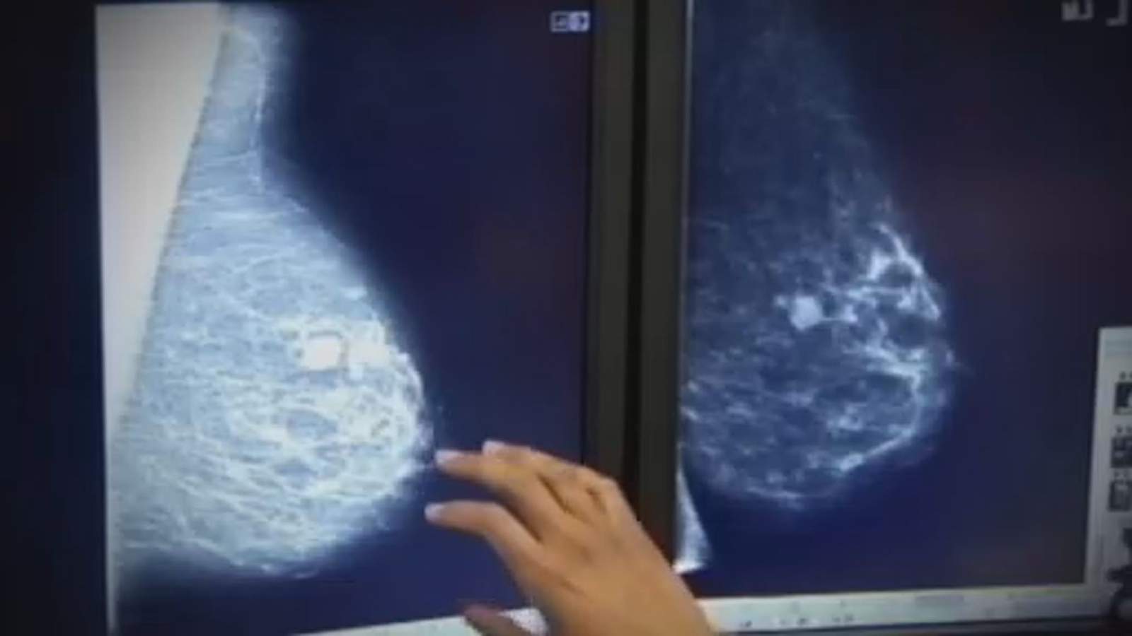Young women are facing breast cancer diagnosis before mammograms are recommended